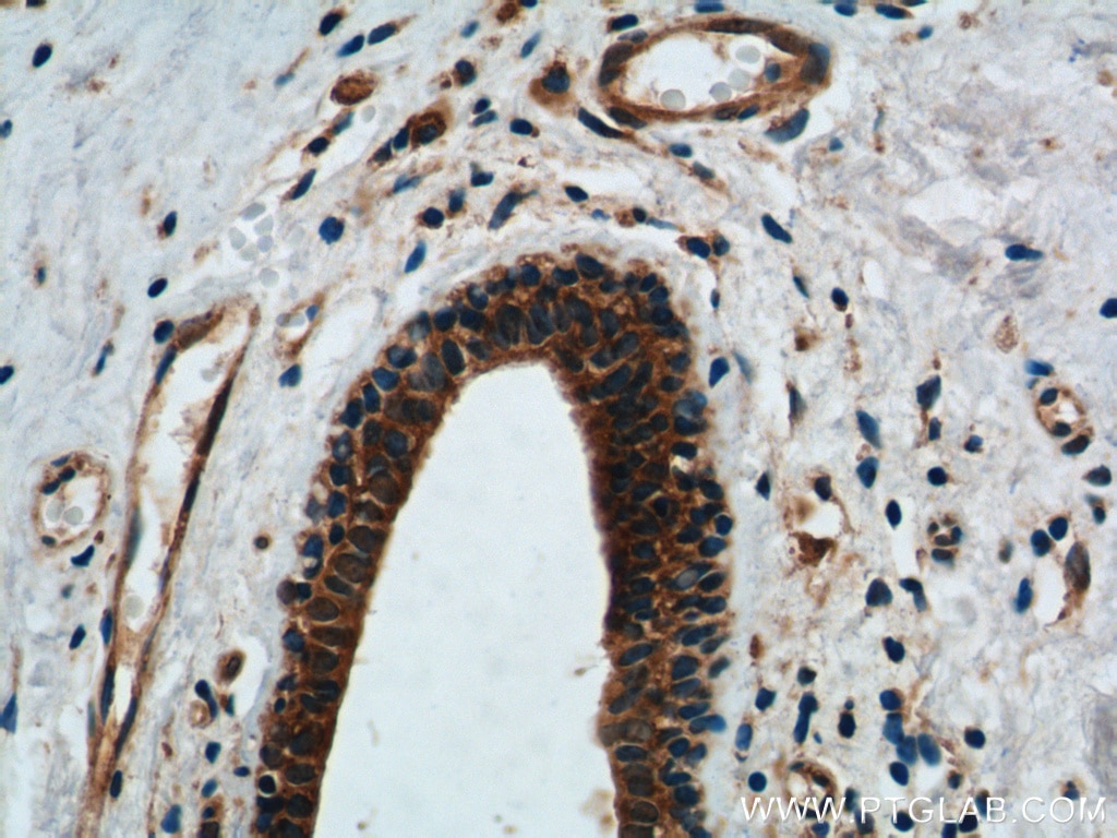 Immunohistochemistry (IHC) staining of human breast cancer tissue using DDX20 Polyclonal antibody (11324-1-AP)