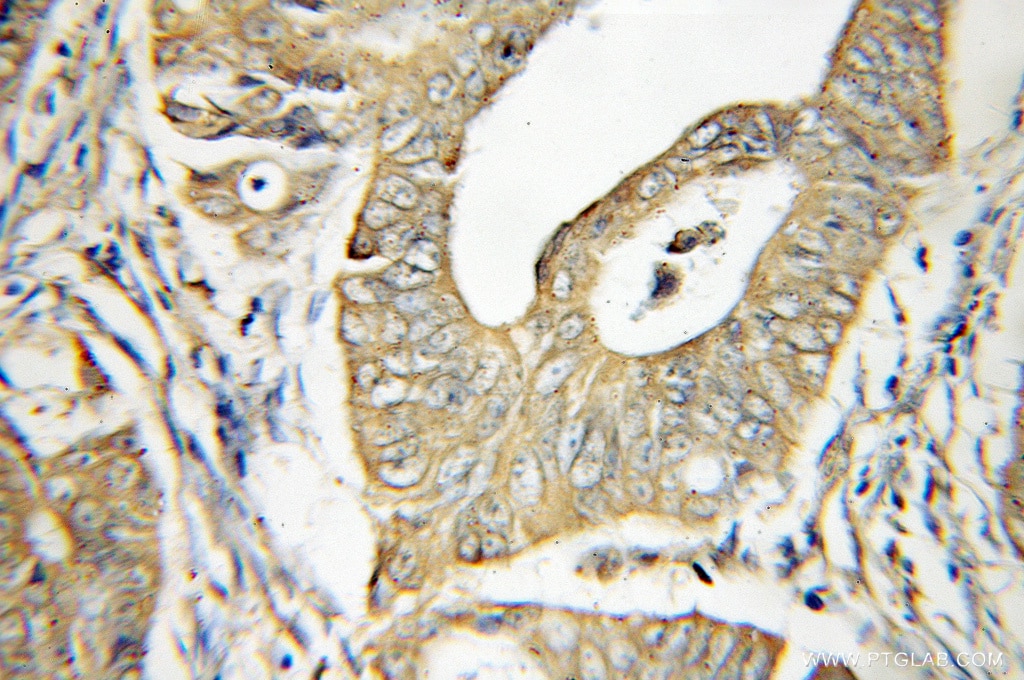 IHC staining of human colon cancer using 11324-1-AP