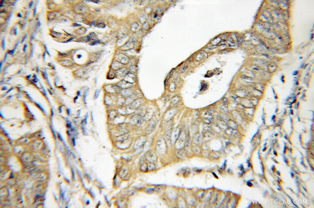 Immunohistochemistry (IHC) staining of human colon cancer tissue using DDX20 Polyclonal antibody (11324-1-AP)