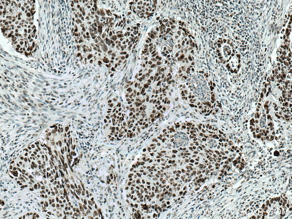 IHC staining of human colon cancer using 10528-1-AP