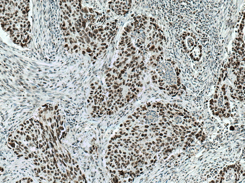 Immunohistochemistry (IHC) staining of human colon cancer tissue using DDX21 Polyclonal antibody (10528-1-AP)