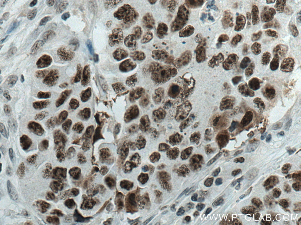 Immunohistochemistry (IHC) staining of human colon cancer tissue using DDX21 Polyclonal antibody (10528-1-AP)