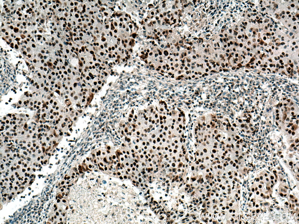 IHC staining of human breast cancer using 10528-1-AP
