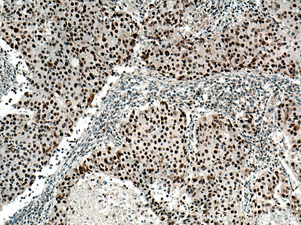 Immunohistochemistry (IHC) staining of human breast cancer tissue using DDX21 Polyclonal antibody (10528-1-AP)