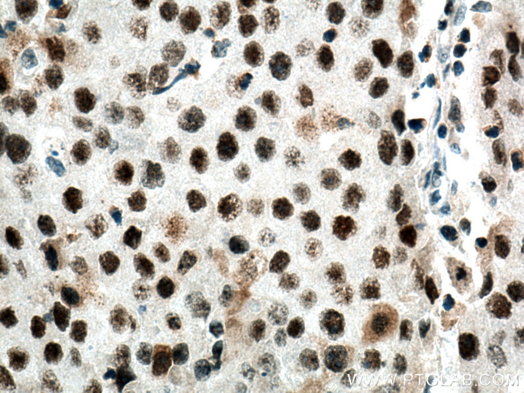 Immunohistochemistry (IHC) staining of human breast cancer tissue using DDX21 Polyclonal antibody (10528-1-AP)