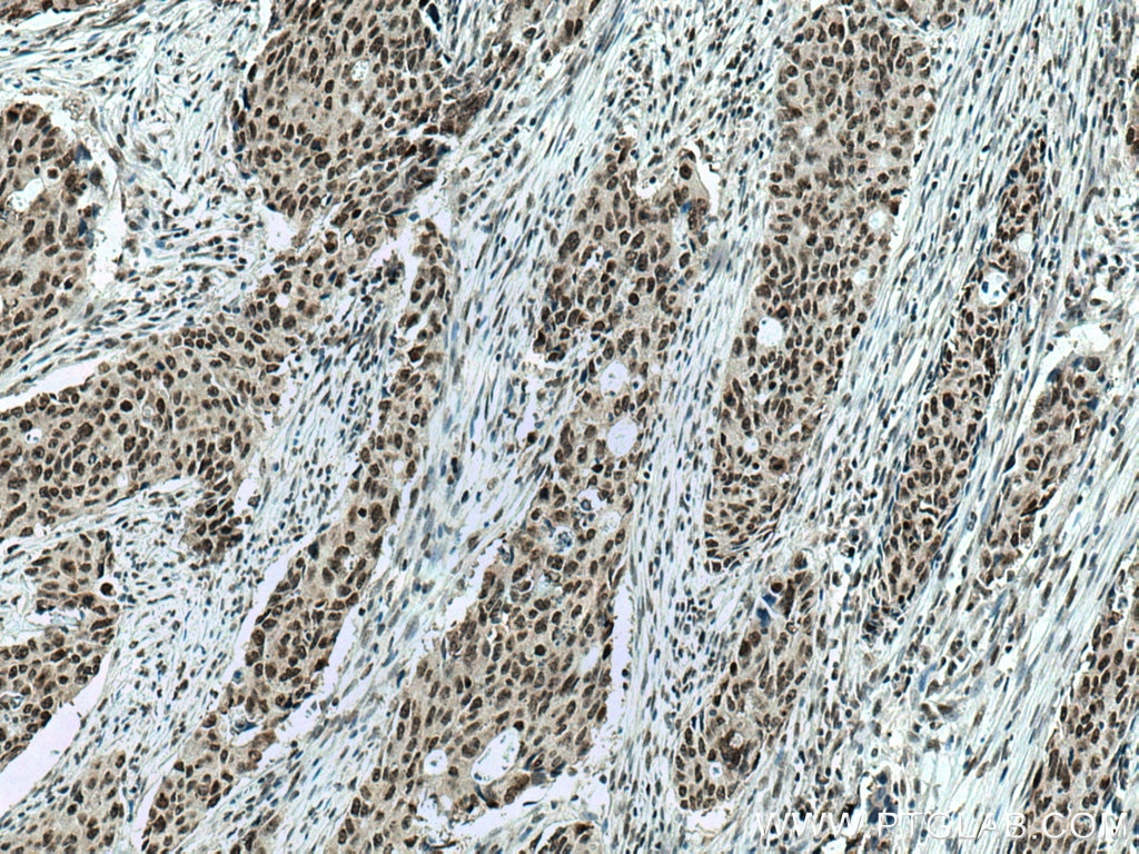 Immunohistochemistry (IHC) staining of human colon cancer tissue using DDX21 Monoclonal antibody (66925-1-Ig)