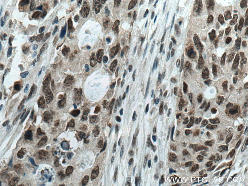 Immunohistochemistry (IHC) staining of human colon cancer tissue using DDX21 Monoclonal antibody (66925-1-Ig)