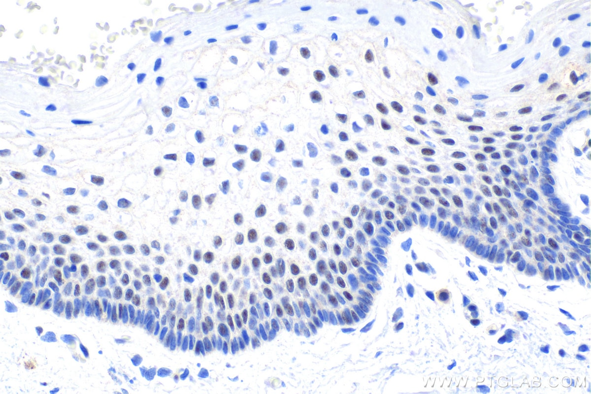 Immunohistochemistry (IHC) staining of human cervical cancer tissue using DDX23 Polyclonal antibody (10199-2-AP)