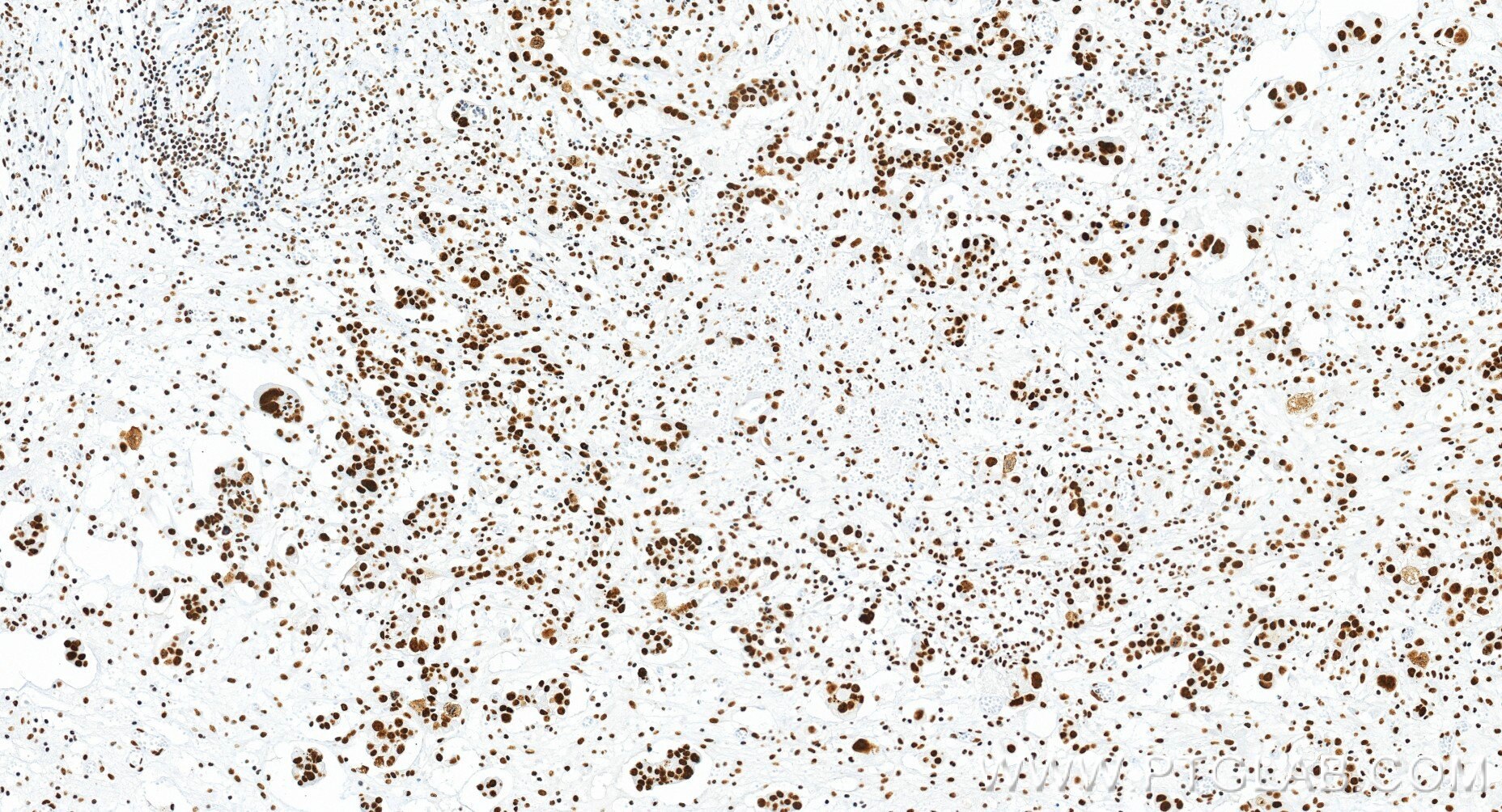 Immunohistochemistry (IHC) staining of human ovary cancer tissue using DDX23 Recombinant monoclonal antibody (85763-4-RR)