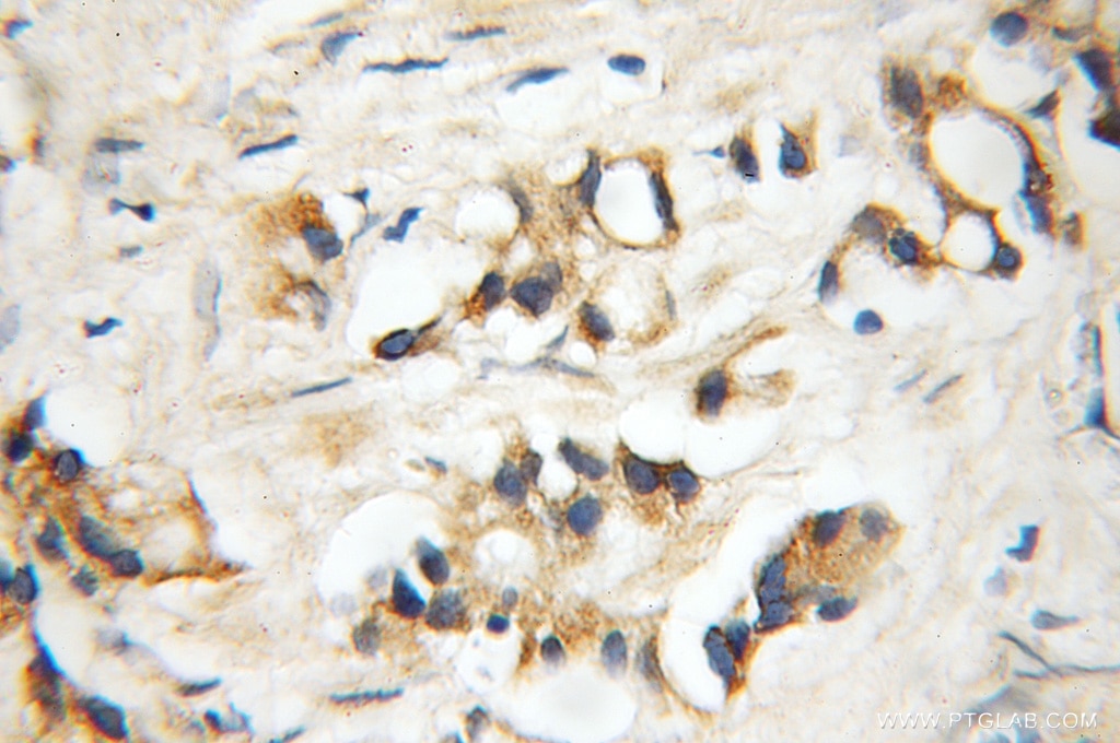Immunohistochemistry (IHC) staining of human prostate cancer tissue using DDX28 Polyclonal antibody (11617-1-AP)