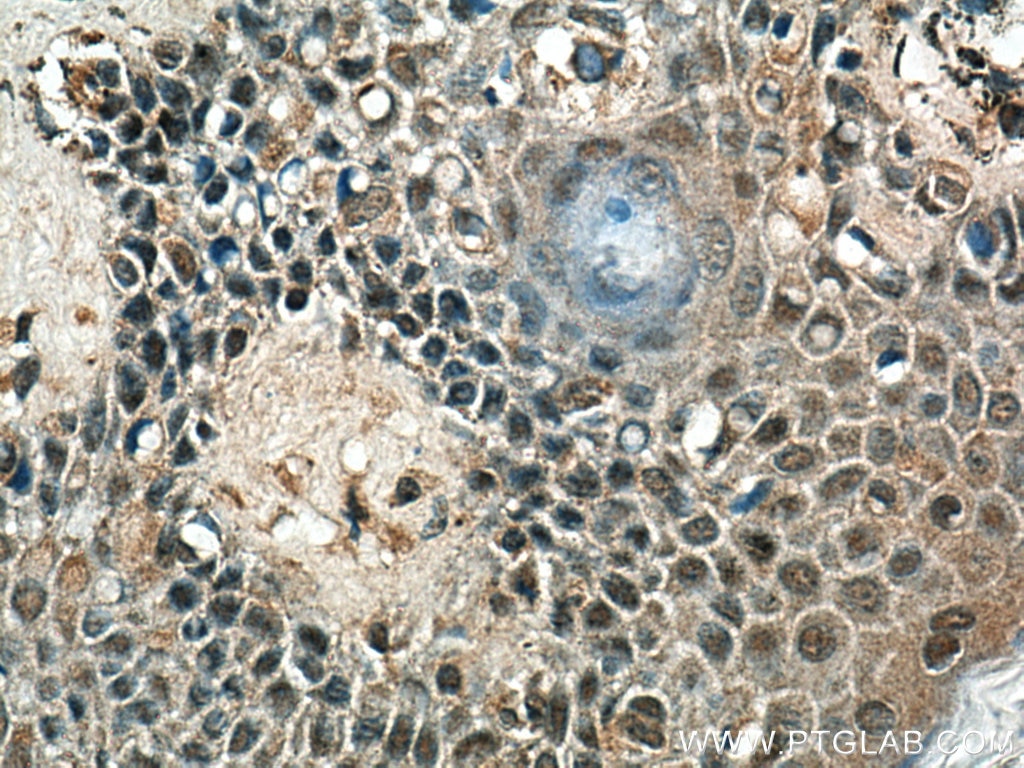 Immunohistochemistry (IHC) staining of human malignant melanoma tissue using DDX3 Polyclonal antibody (11115-1-AP)