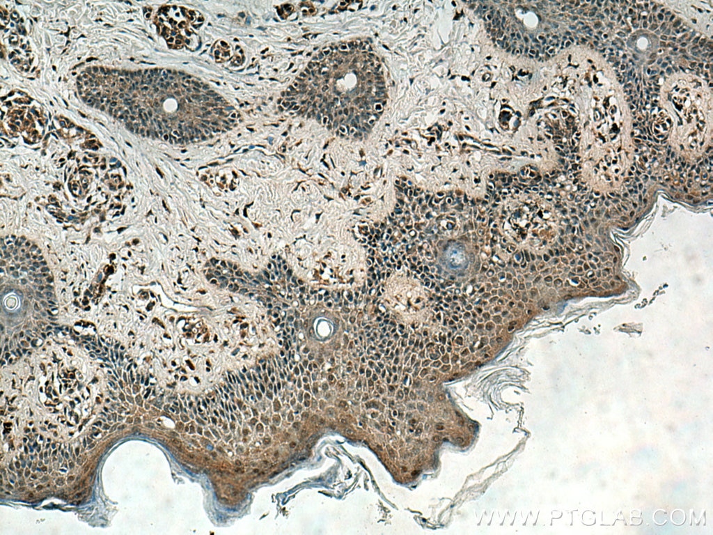 IHC staining of human malignant melanoma using 11115-1-AP