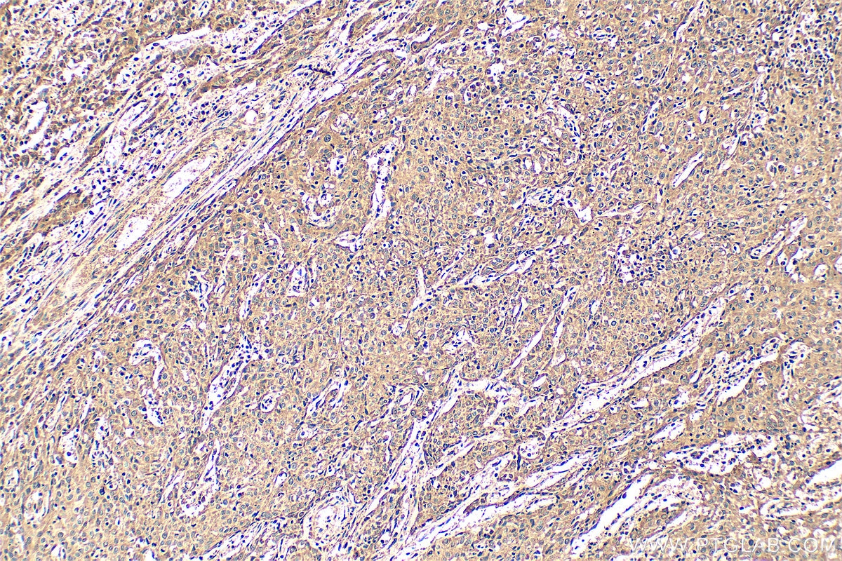 Immunohistochemical analysis of paraffin-embedded human cervical cancer tissue slide using 11115-1-AP (DDX3 antibody) at dilution of 1:200 (under 10x lens). Heat mediated antigen retrieval with Tris-EDTA buffer (pH 9.0). Immunohistochemistry (IHC) staining of human cervical cancer tissue using DDX3 Polyclonal antibody (11115-1-AP)