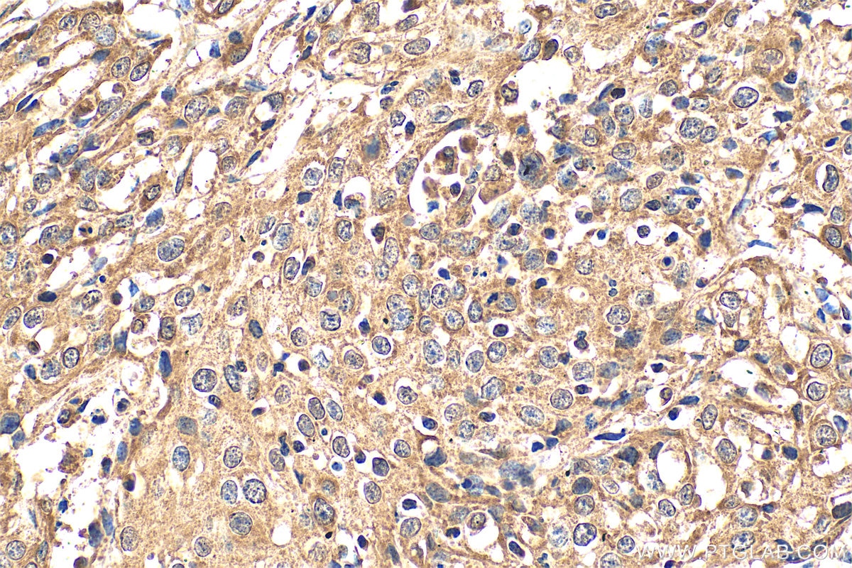 Immunohistochemical analysis of paraffin-embedded human cervical cancer tissue slide using 11115-1-AP (DDX3 antibody) at dilution of 1:200 (under 40x lens). Heat mediated antigen retrieval with Tris-EDTA buffer (pH 9.0). Immunohistochemistry (IHC) staining of human cervical cancer tissue using DDX3 Polyclonal antibody (11115-1-AP)