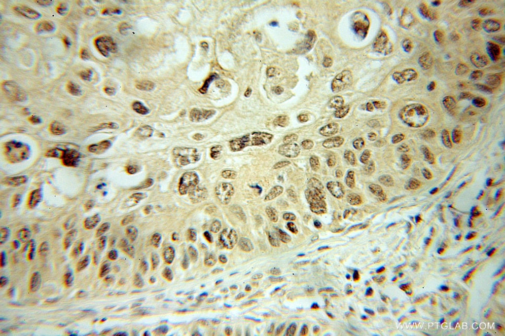 Immunohistochemistry (IHC) staining of human cervical cancer tissue using DDX3 Polyclonal antibody (11115-1-AP)