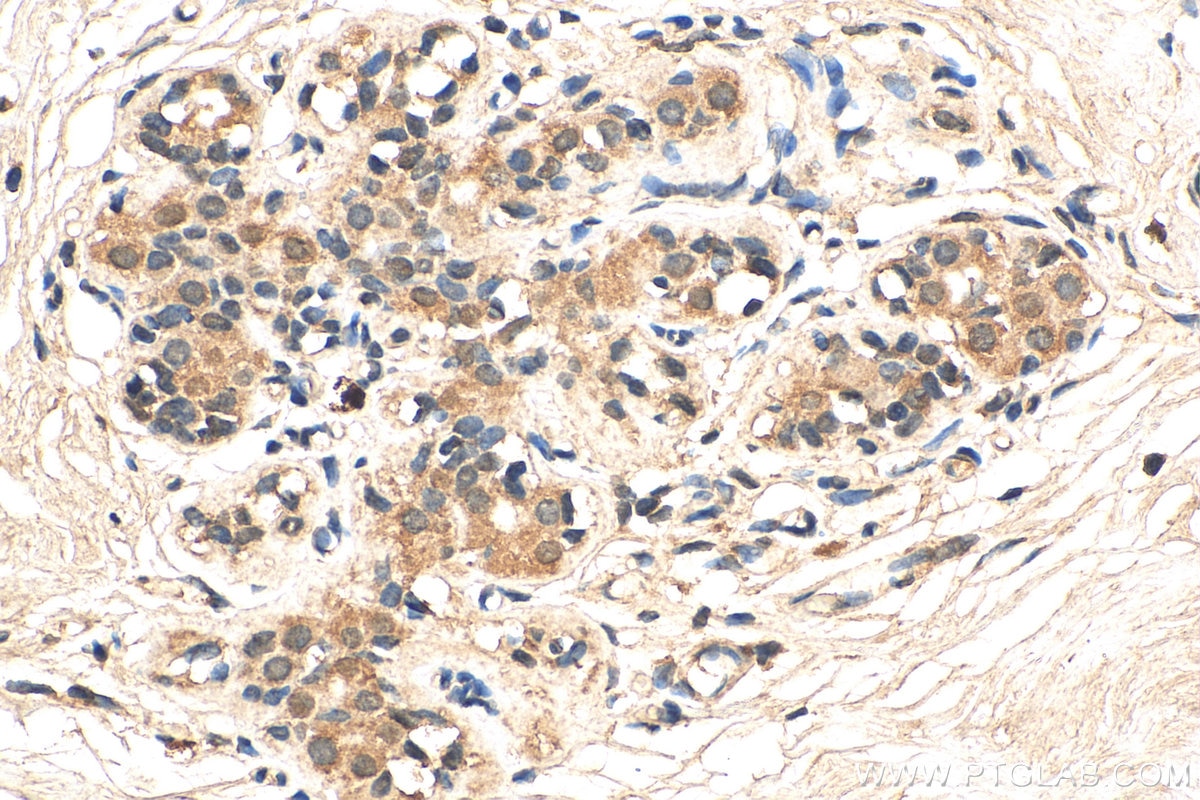 Immunohistochemistry (IHC) staining of human breast cancer tissue using DDX3 Monoclonal antibody (67915-1-Ig)