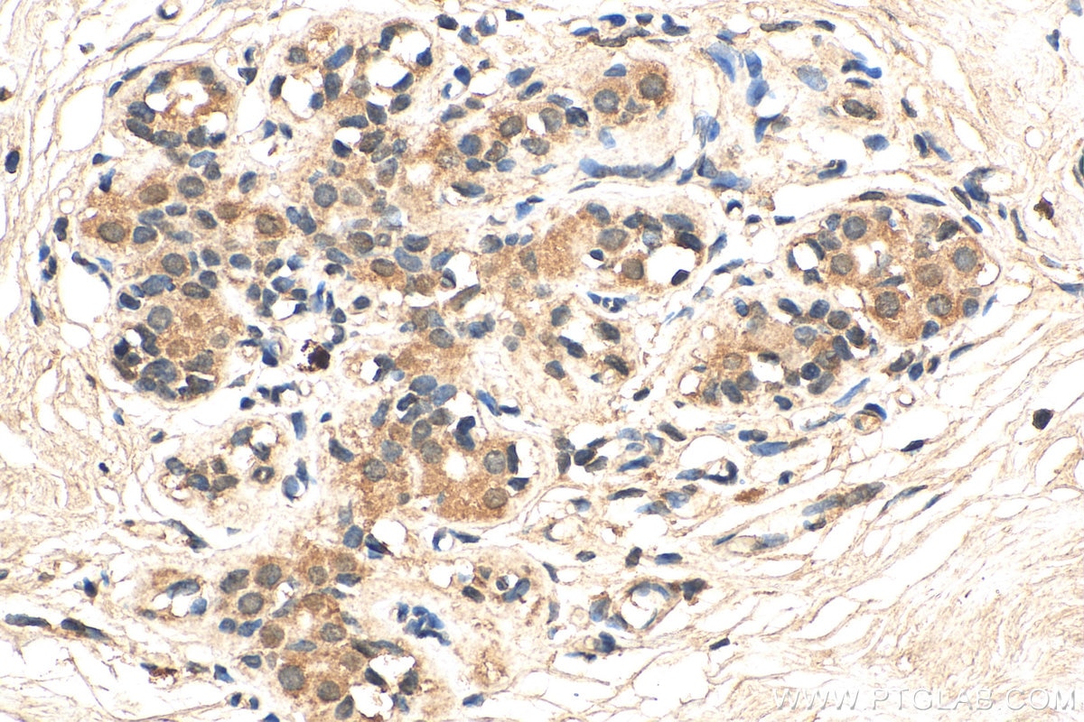 IHC staining of human breast cancer using 67915-1-Ig