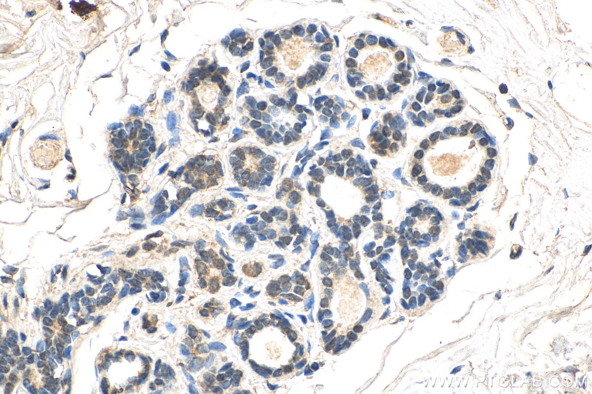 IHC staining of human breast cancer using 67915-1-Ig