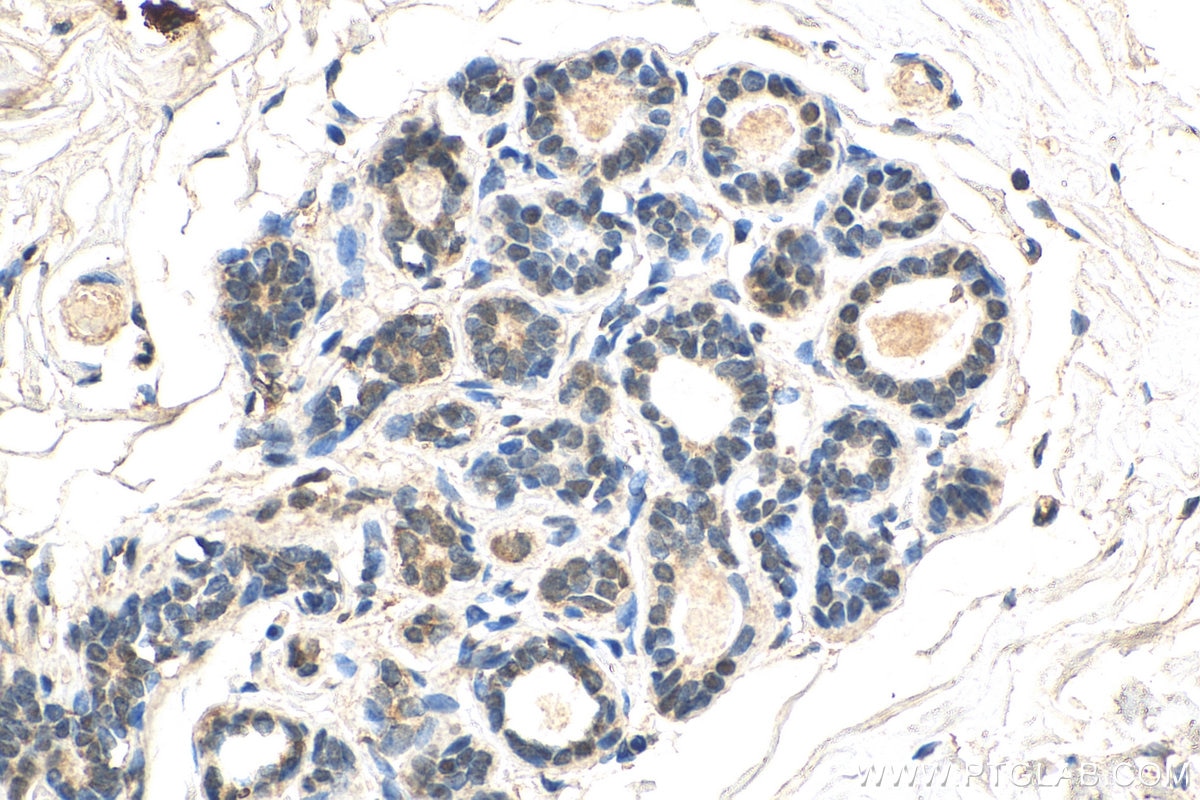 Immunohistochemistry (IHC) staining of human breast cancer tissue using DDX3 Monoclonal antibody (67915-1-Ig)