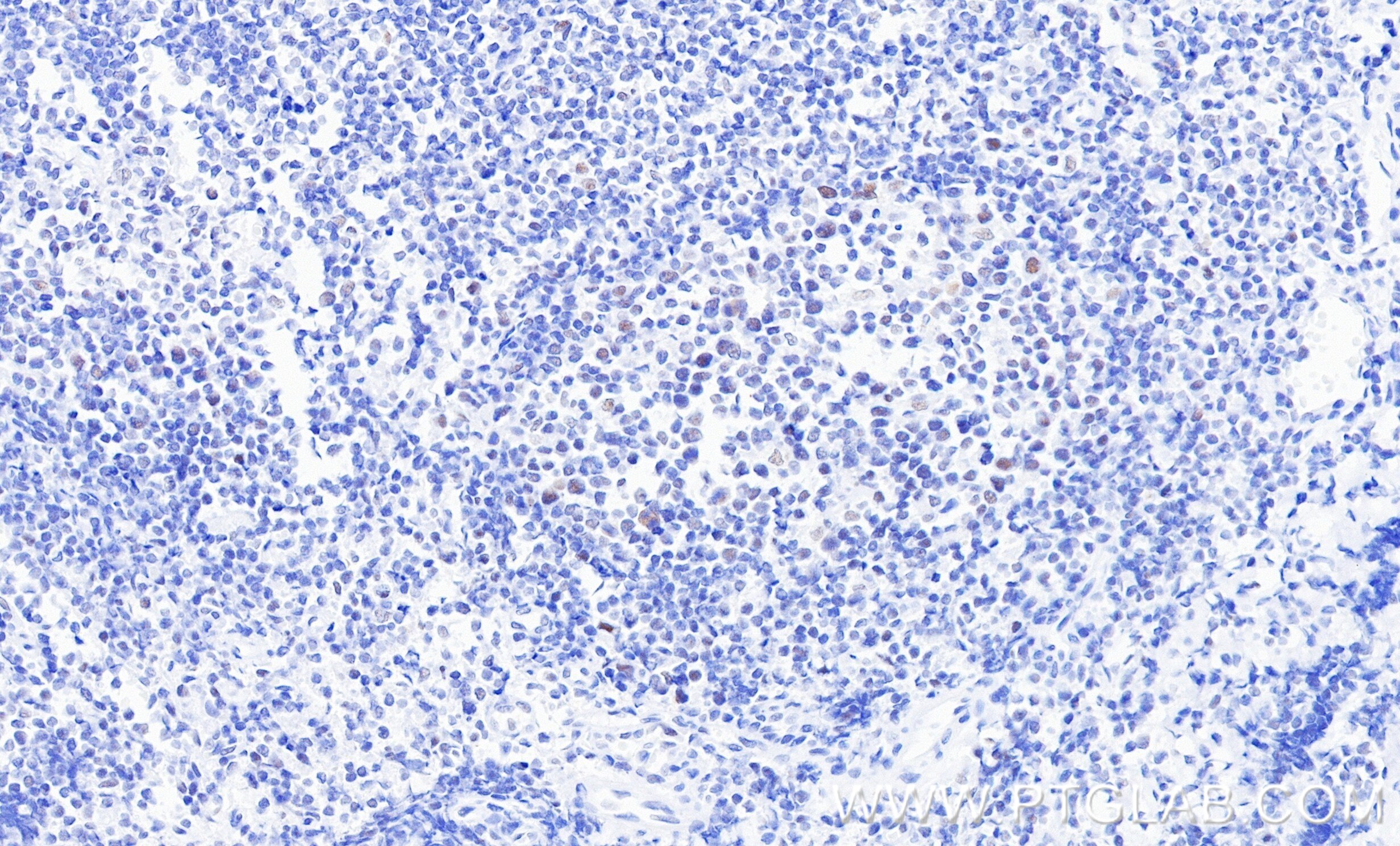 Immunohistochemistry (IHC) staining of human tonsillitis tissue using DDX41 Recombinant monoclonal antibody (86894-1-RR)