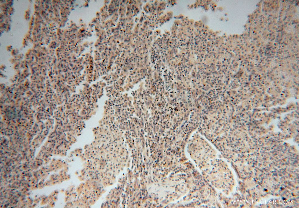 IHC staining of human lung cancer using 17591-1-AP