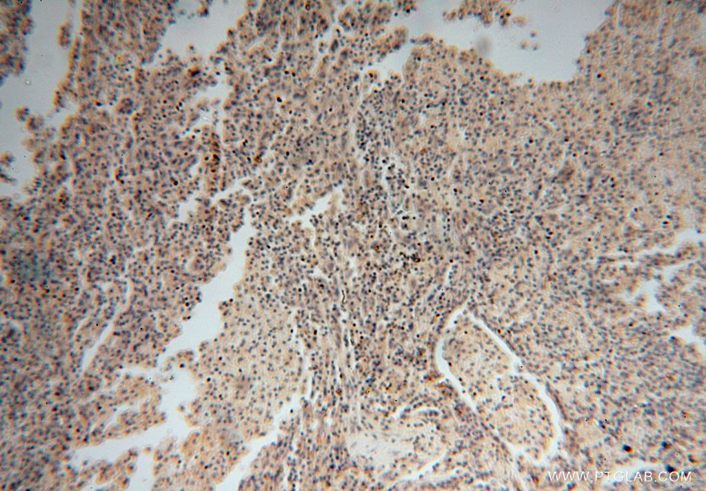Immunohistochemistry (IHC) staining of human lung cancer tissue using DDX43 Polyclonal antibody (17591-1-AP)