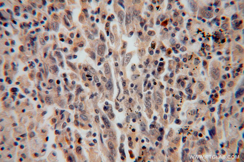 Immunohistochemistry (IHC) staining of human lung cancer tissue using DDX43 Polyclonal antibody (17591-1-AP)