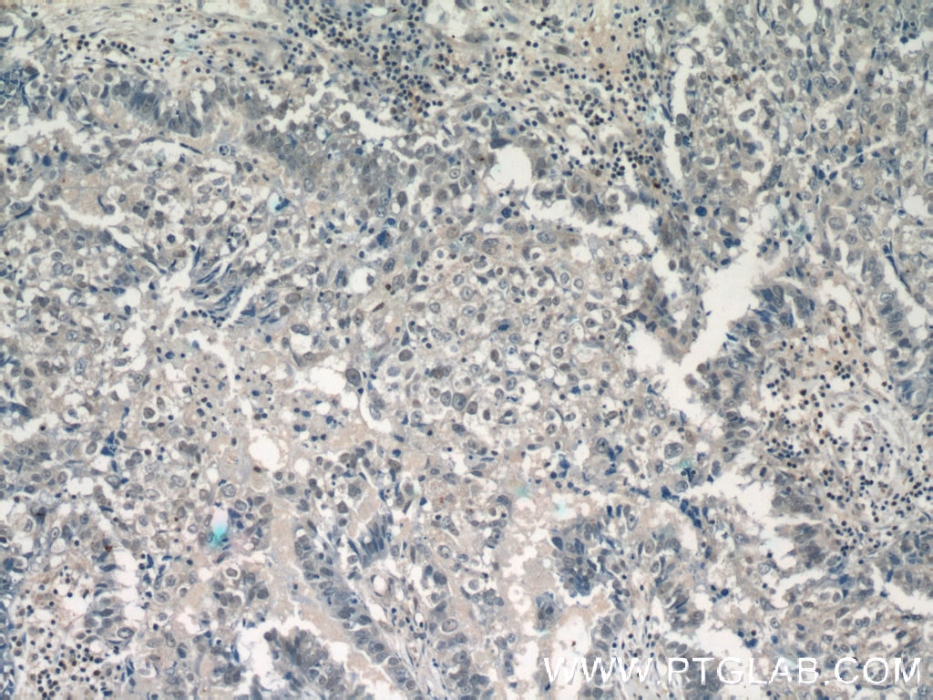 Immunohistochemistry (IHC) staining of human breast cancer tissue using DDX5 Polyclonal antibody (10804-1-AP)