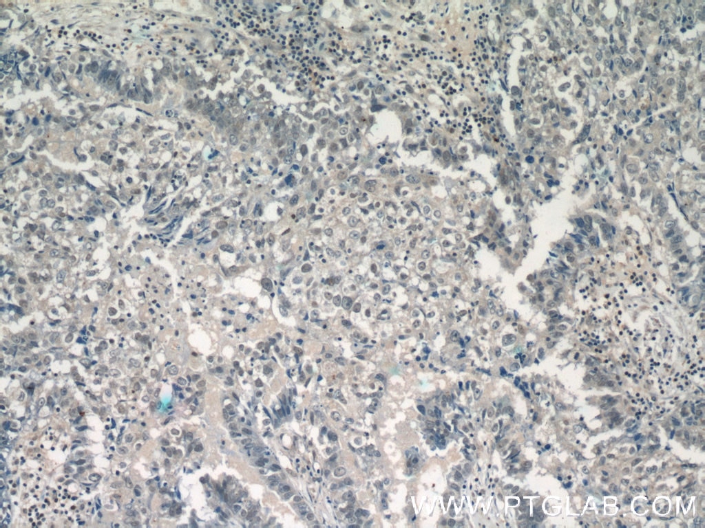 Immunohistochemistry (IHC) staining of human breast cancer tissue using DDX5,p68 Polyclonal antibody (10804-1-AP)