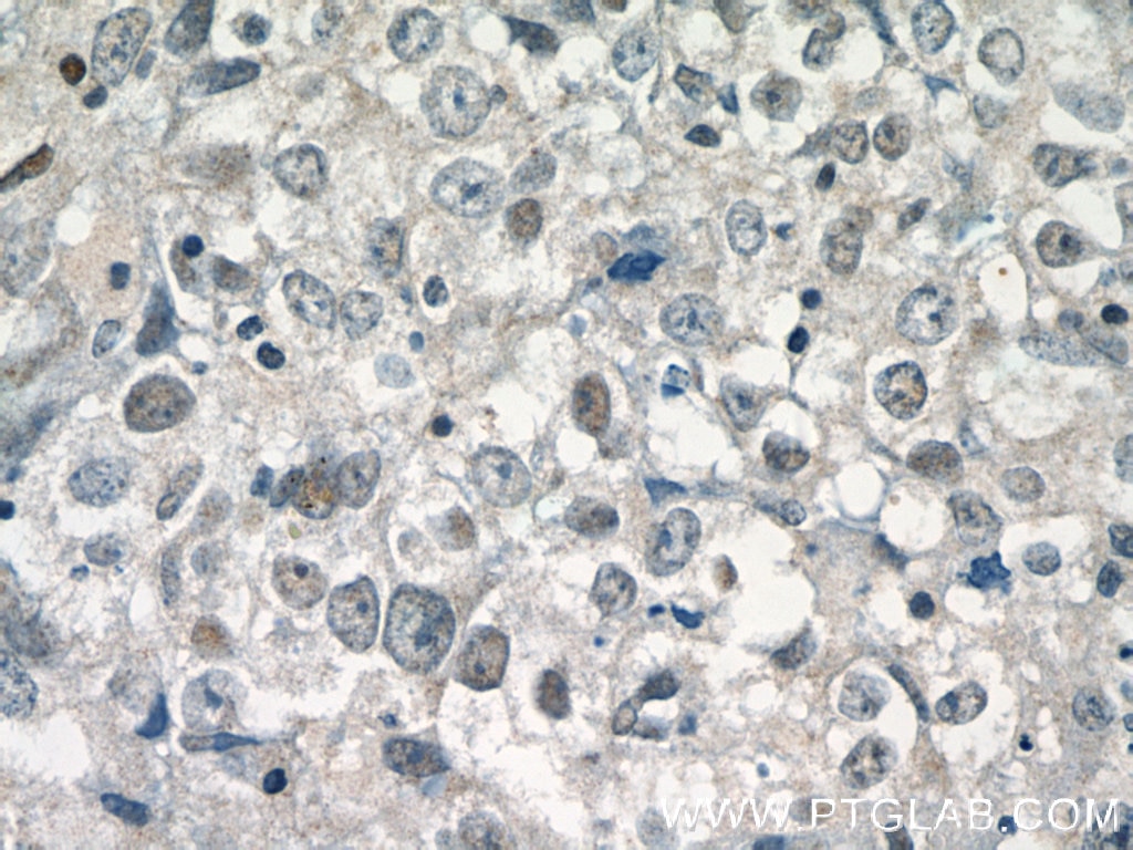 Immunohistochemistry (IHC) staining of human breast cancer tissue using DDX5 Polyclonal antibody (10804-1-AP)