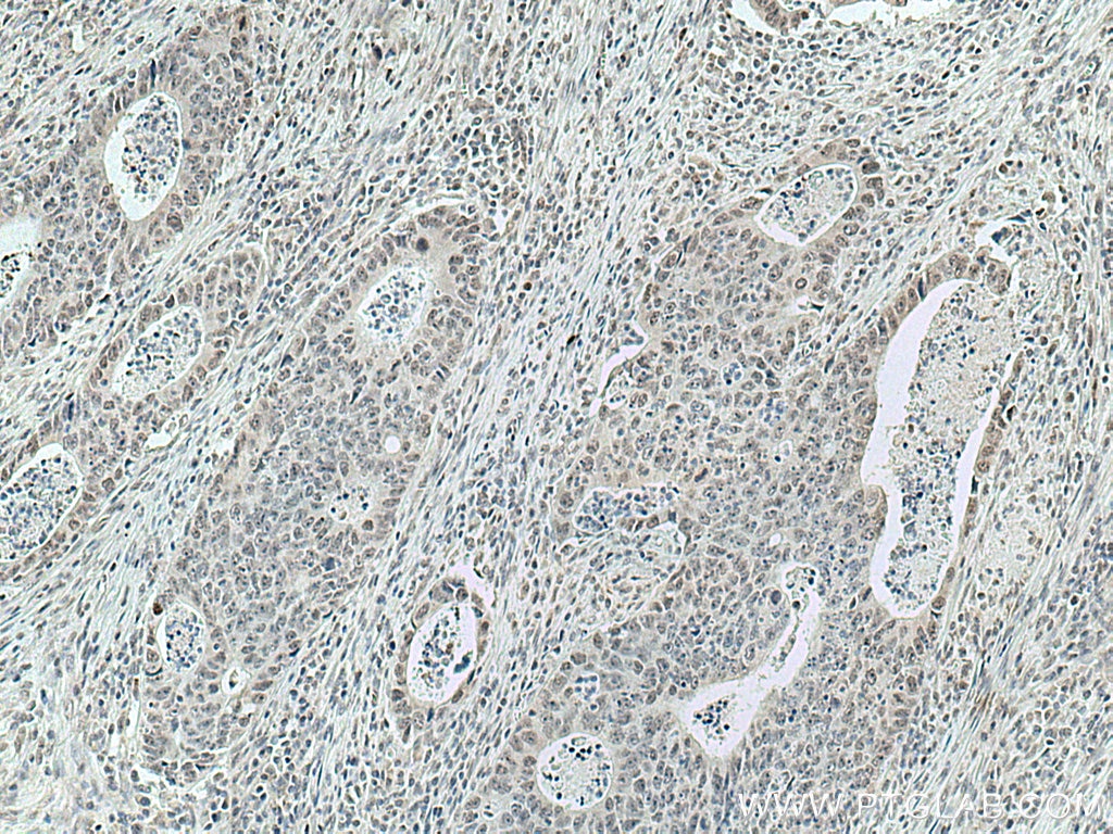 Immunohistochemistry (IHC) staining of human colon cancer tissue using DDX5 Monoclonal antibody (67025-1-Ig)
