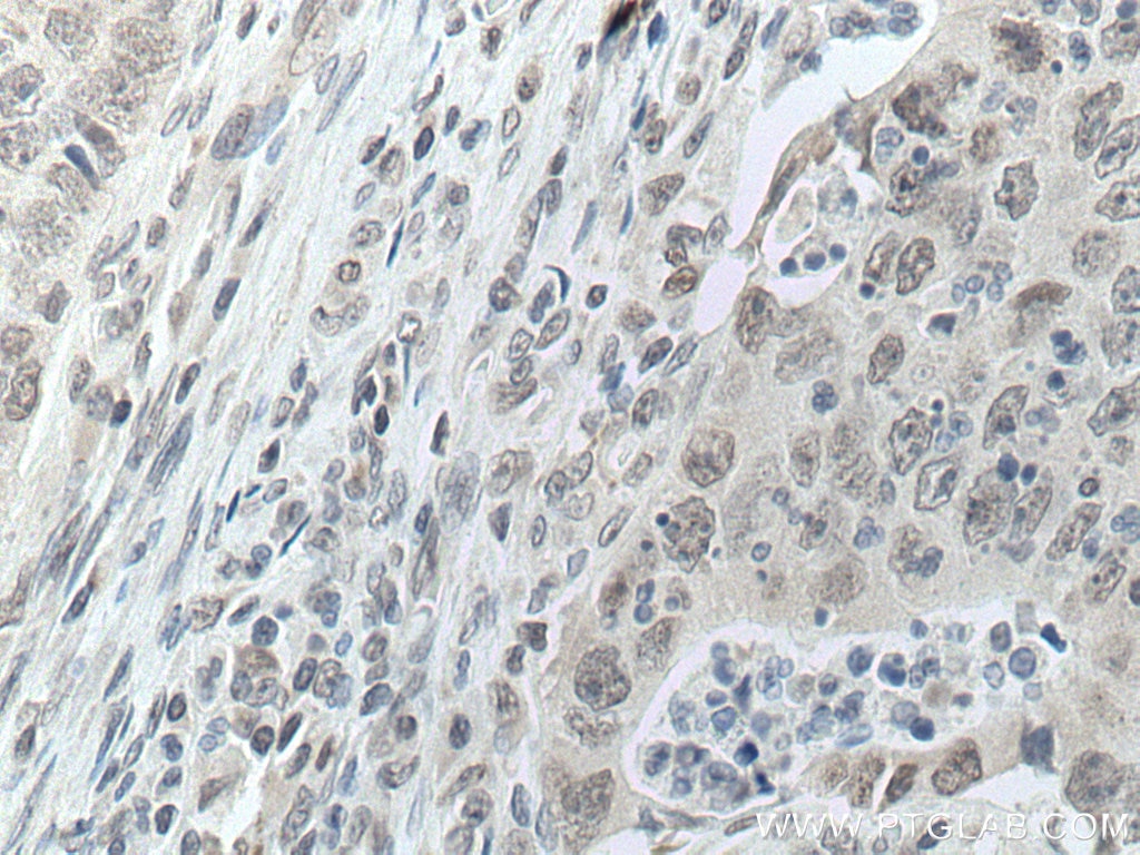 Immunohistochemistry (IHC) staining of human colon cancer tissue using DDX5 Monoclonal antibody (67025-1-Ig)