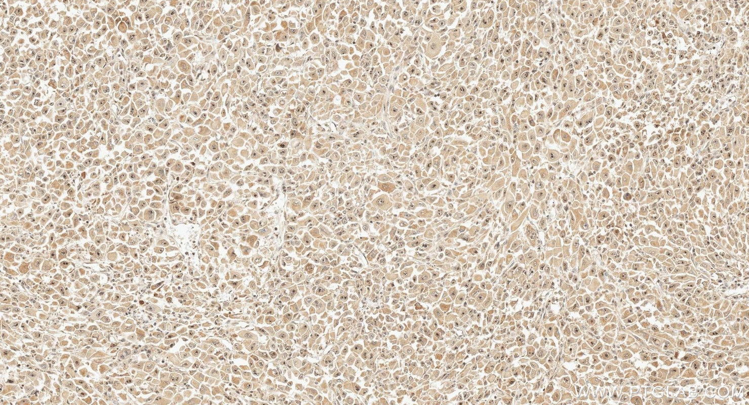 Immunohistochemistry (IHC) staining of human stomach cancer tissue using DDX54 Polyclonal antibody (26894-1-AP)