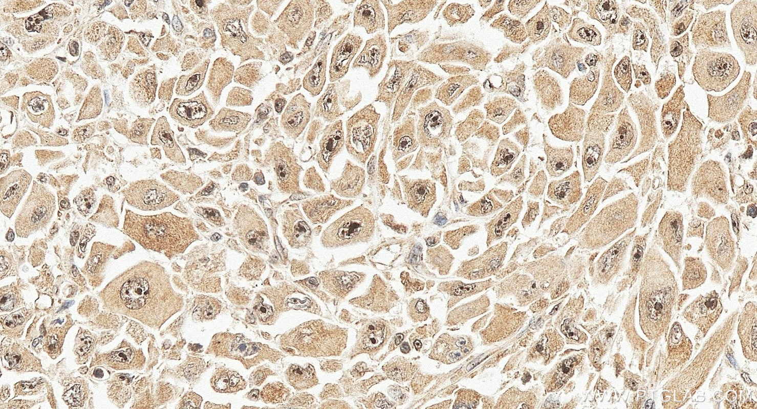 Immunohistochemistry (IHC) staining of human stomach cancer tissue using DDX54 Polyclonal antibody (26894-1-AP)