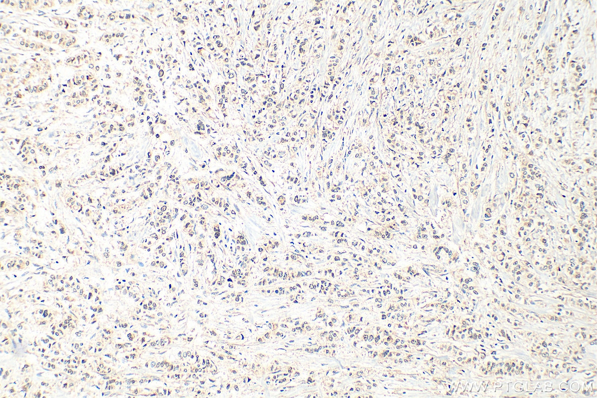 Immunohistochemistry (IHC) staining of human breast cancer tissue using DDX59 Polyclonal antibody (32948-1-AP)
