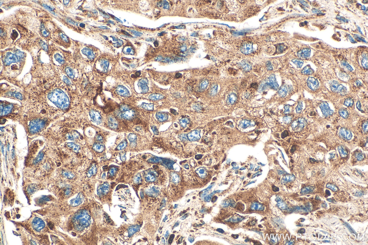Immunohistochemistry (IHC) staining of human lung cancer tissue using DDX60 Recombinant antibody (82969-4-RR)