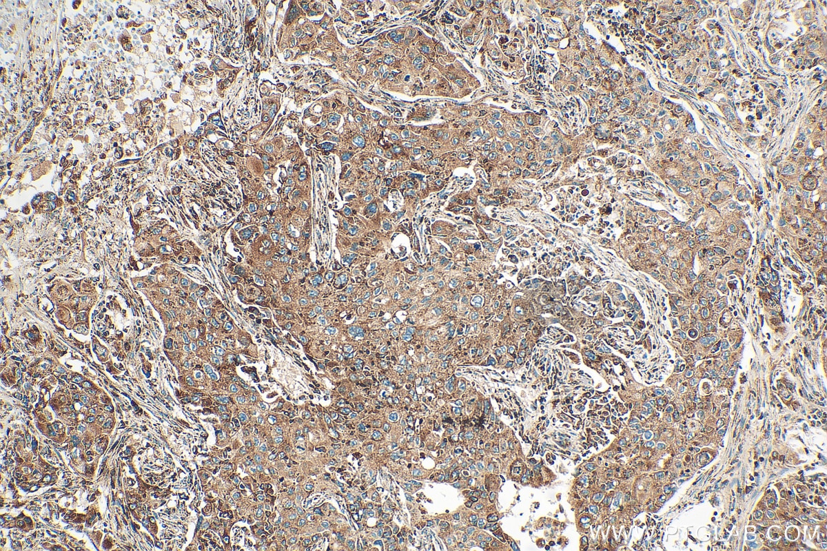 Immunohistochemistry (IHC) staining of human lung cancer tissue using DDX60 Recombinant antibody (82969-4-RR)