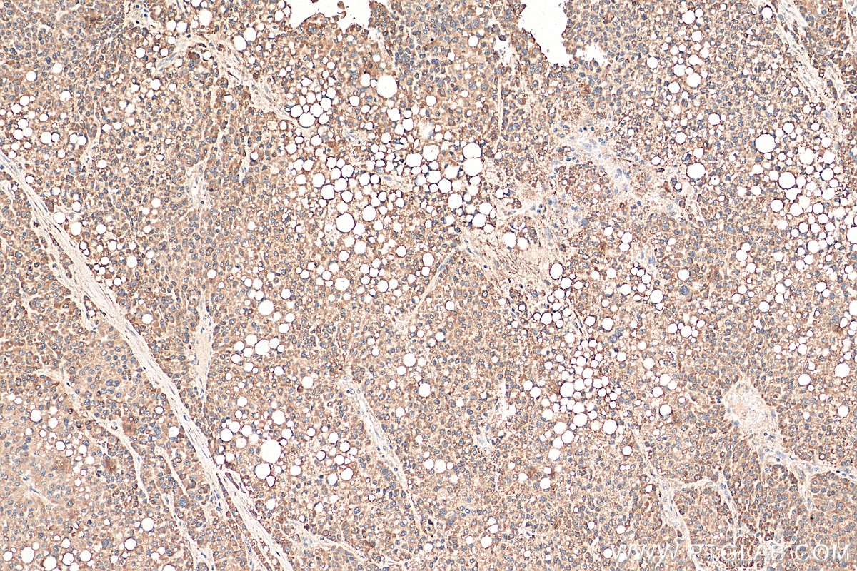 Immunohistochemistry (IHC) staining of human liver cancer tissue using DEAF1 Polyclonal antibody (18323-1-AP)