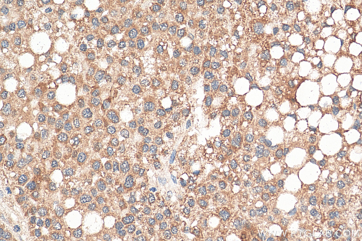 Immunohistochemistry (IHC) staining of human liver cancer tissue using DEAF1 Polyclonal antibody (18323-1-AP)