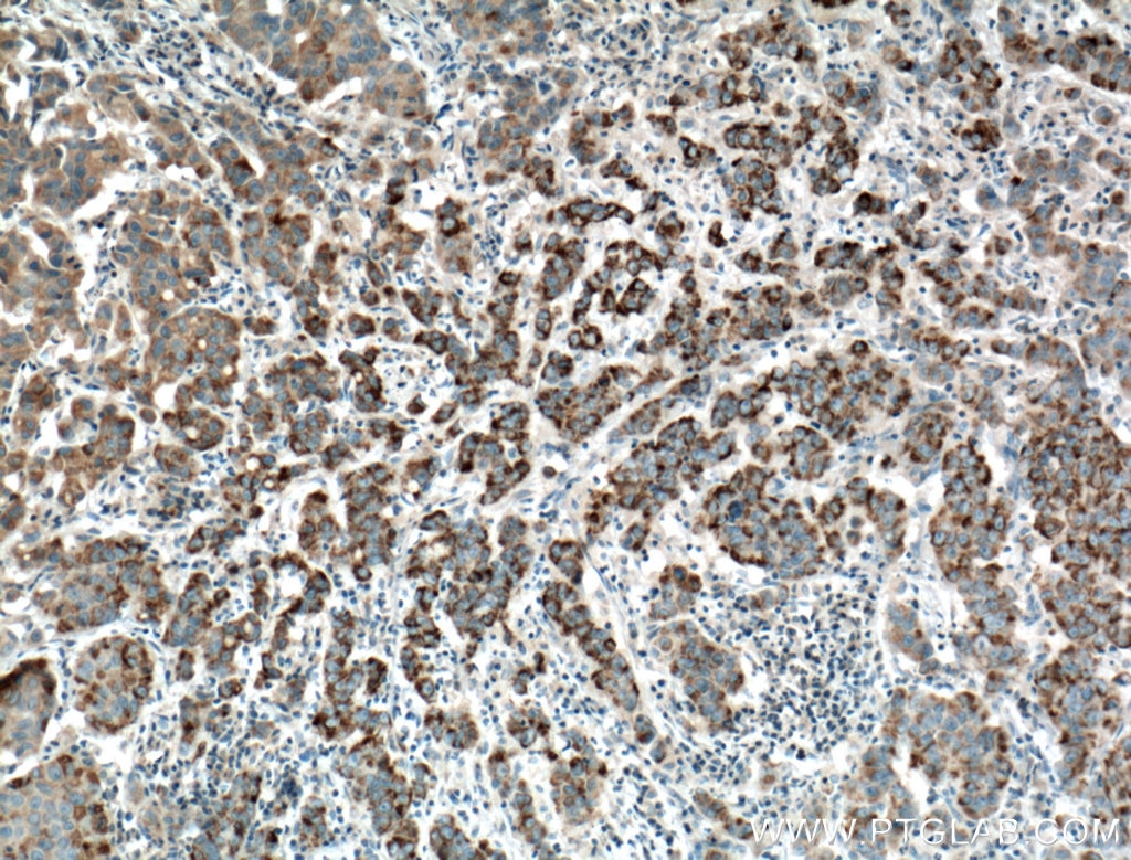 IHC staining of human prostate cancer using 25021-1-AP