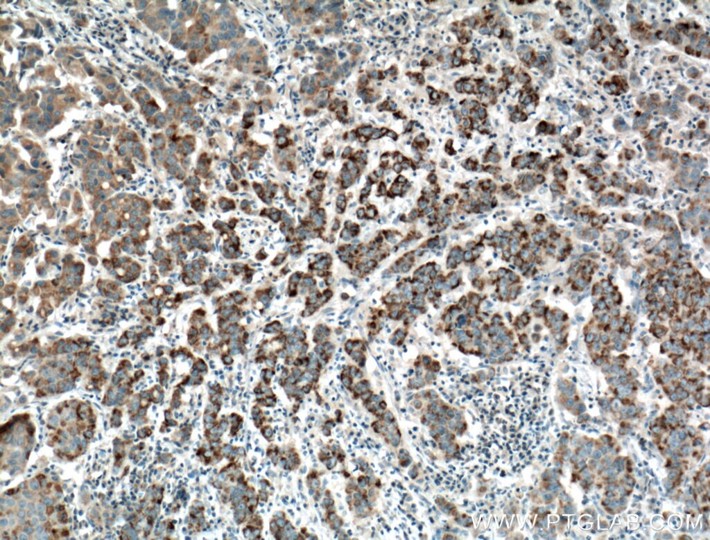 Immunohistochemistry (IHC) staining of human prostate cancer tissue using DEC1 Polyclonal antibody (25021-1-AP)