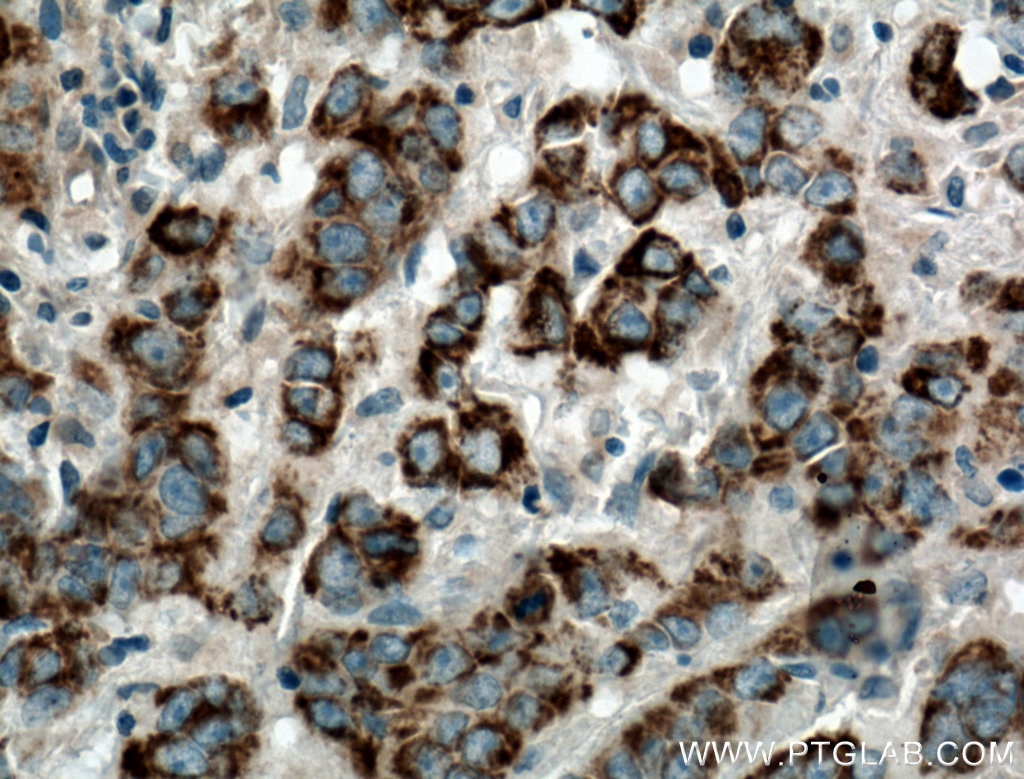 Immunohistochemistry (IHC) staining of human prostate cancer tissue using DEC1 Polyclonal antibody (25021-1-AP)