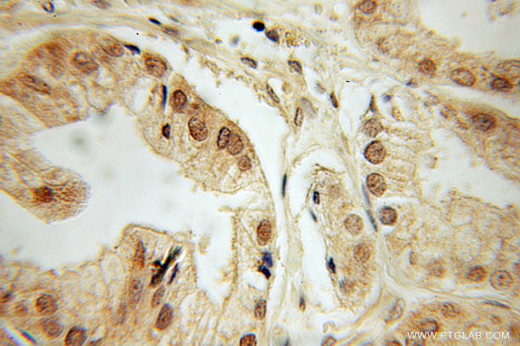 Immunohistochemistry (IHC) staining of human prostate cancer tissue using DEDD Polyclonal antibody (10816-1-AP)