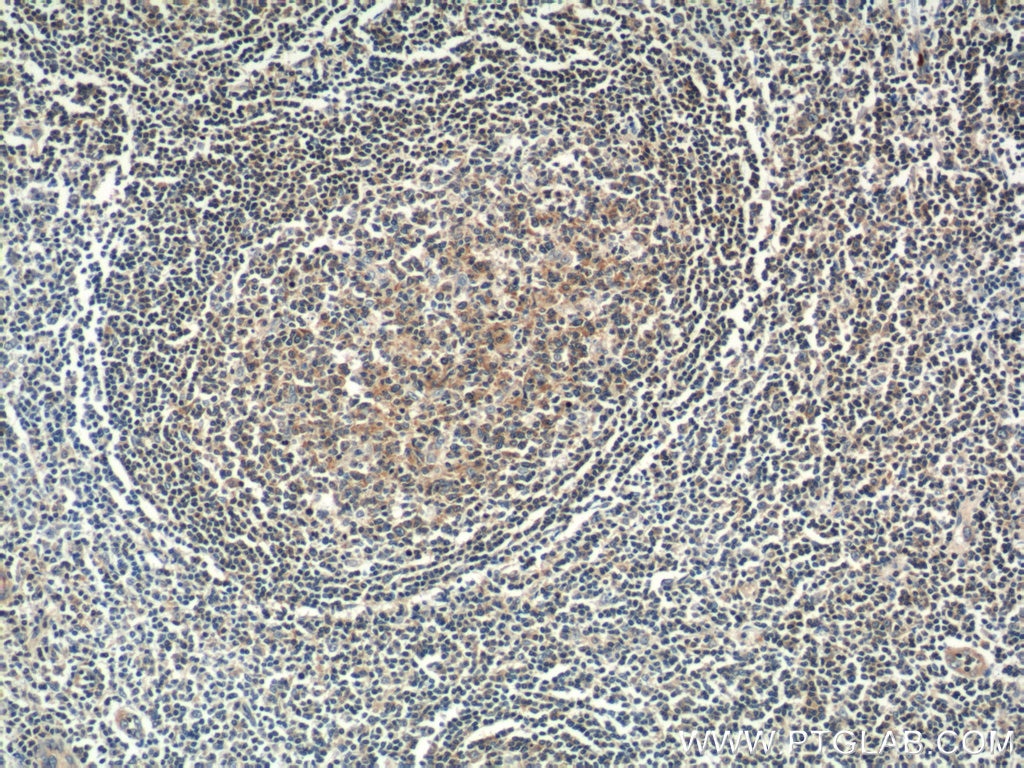 Immunohistochemistry (IHC) staining of human tonsillitis tissue using DEF6 Polyclonal antibody (11369-1-AP)