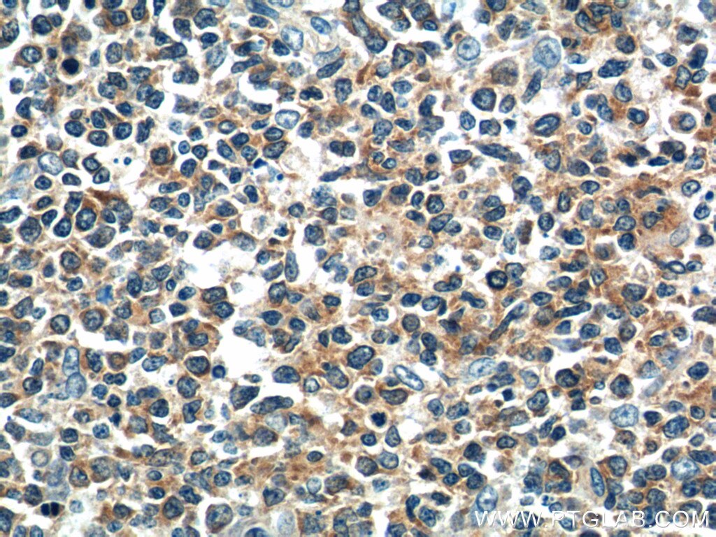 Immunohistochemistry (IHC) staining of human tonsillitis tissue using DEF6 Polyclonal antibody (11369-1-AP)