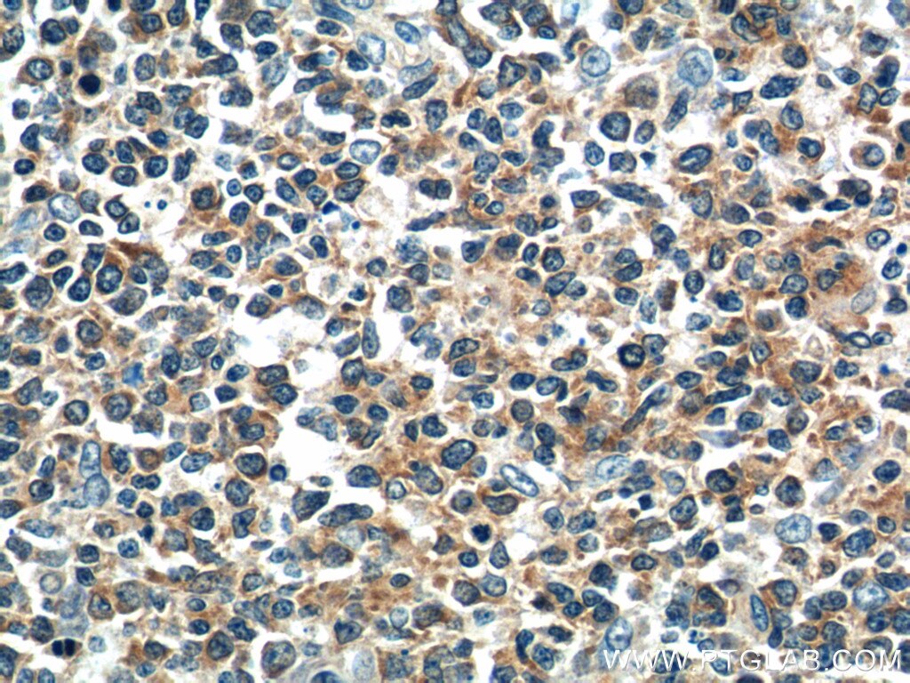 IHC staining of human tonsillitis using 11369-1-AP