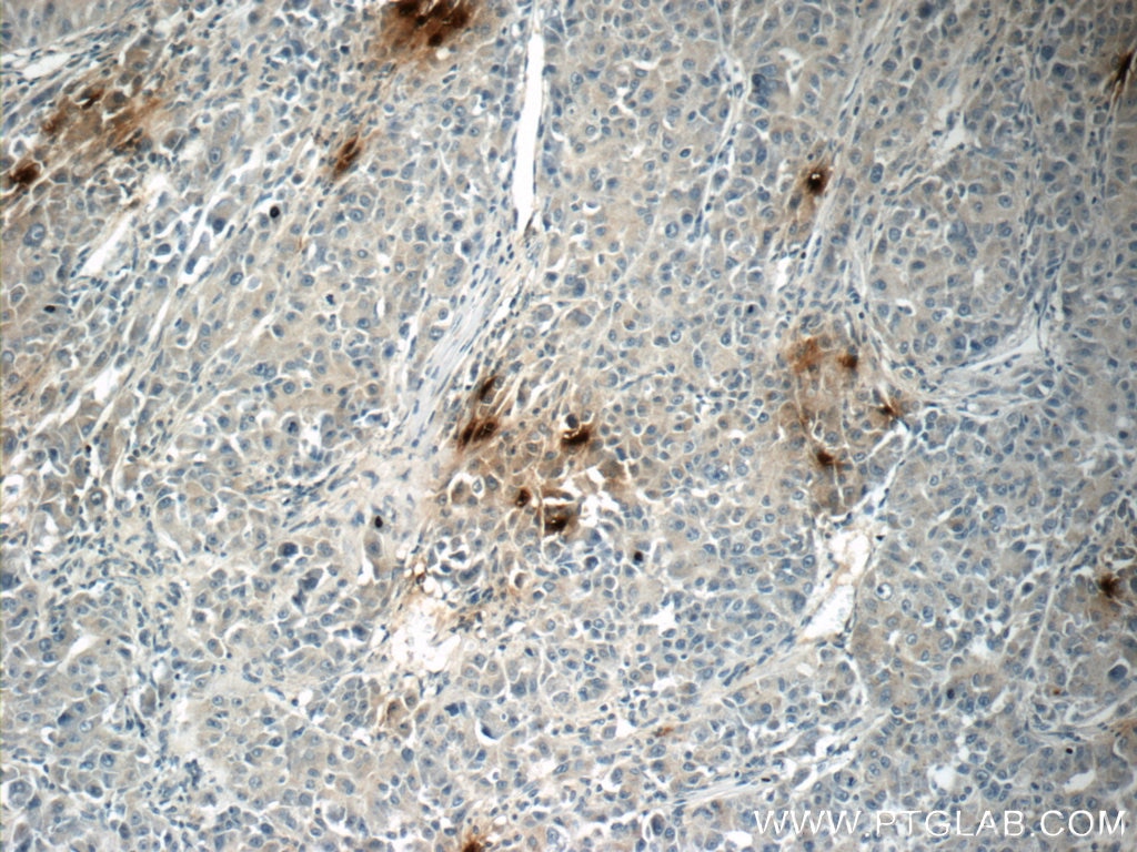 Immunohistochemistry (IHC) staining of human liver cancer tissue using DEFA1 Polyclonal antibody (18057-1-AP)