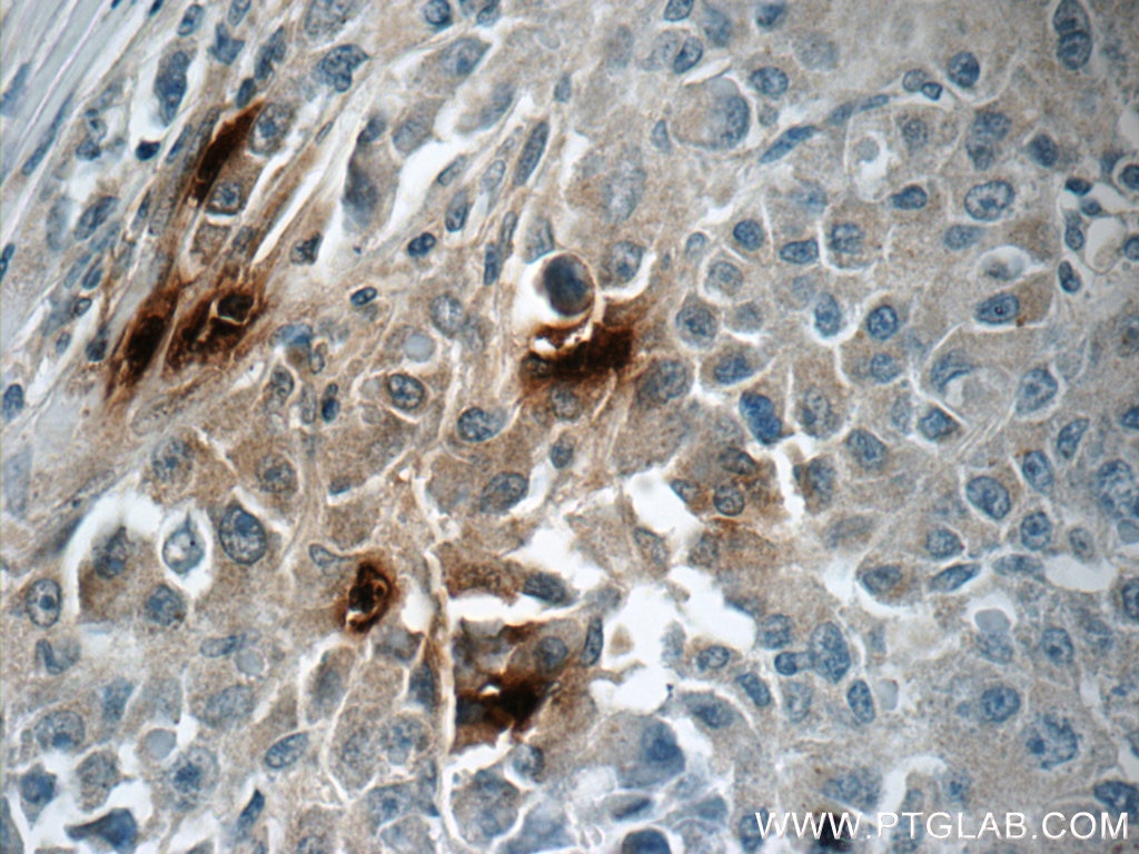 Immunohistochemistry (IHC) staining of human liver cancer tissue using DEFA1 Polyclonal antibody (18057-1-AP)