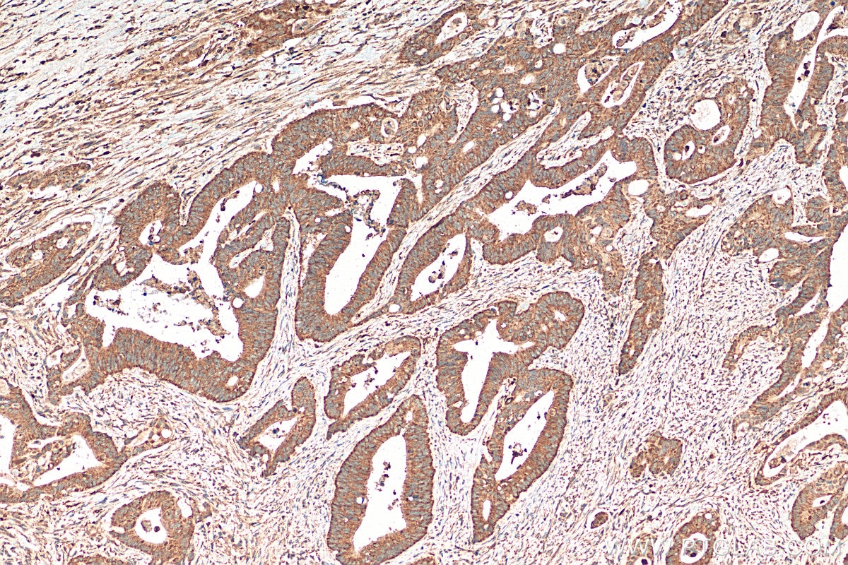 Immunohistochemistry (IHC) staining of human colon cancer tissue using DEFB1 Polyclonal antibody (14738-1-AP)
