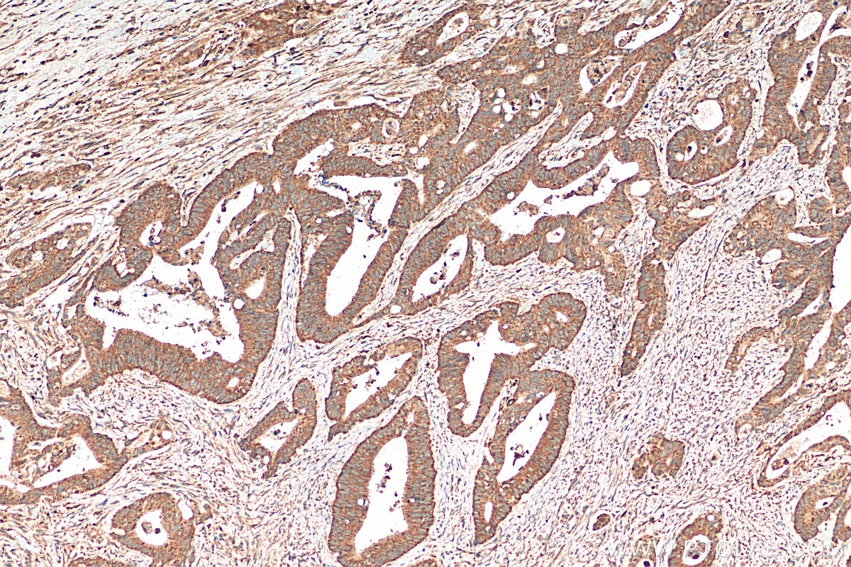 IHC staining of human colon cancer using 14738-1-AP